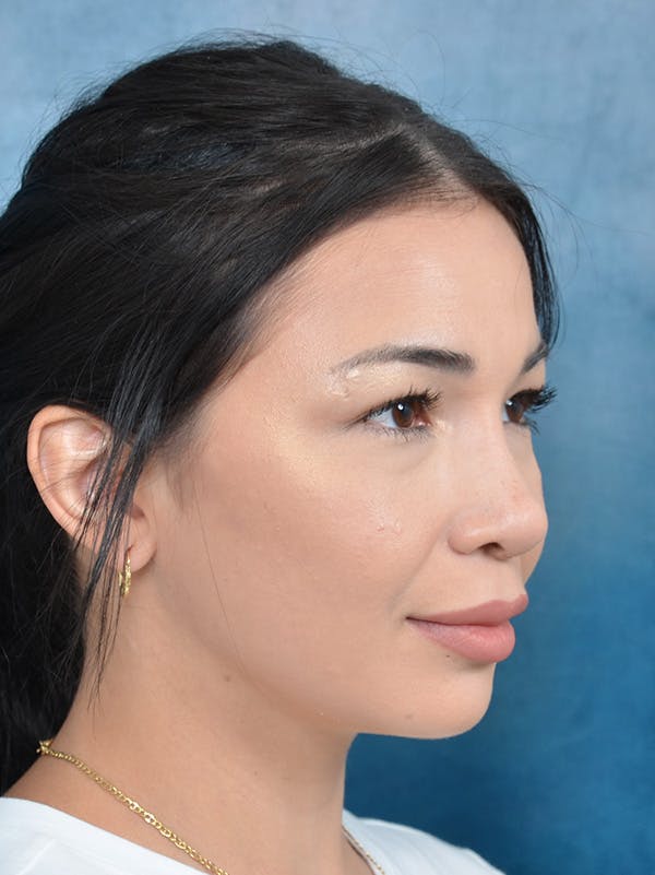 Rhinoplasty Before & After Gallery - Patient 122749877 - Image 6