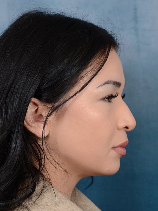Rhinoplasty Before & After Gallery - Patient 122749877 - Image 7