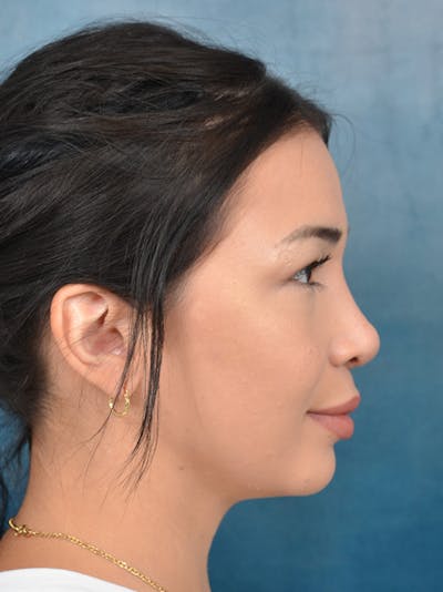 Rhinoplasty Before & After Gallery - Patient 122749877 - Image 8