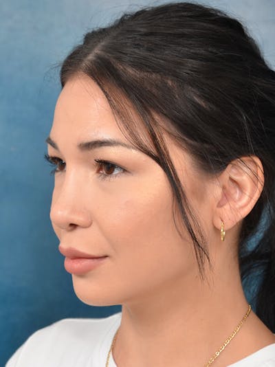 Rhinoplasty Before & After Gallery - Patient 122749877 - Image 10