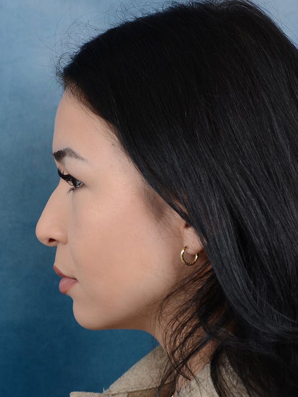 Rhinoplasty Before & After Gallery - Patient 122749877 - Image 1