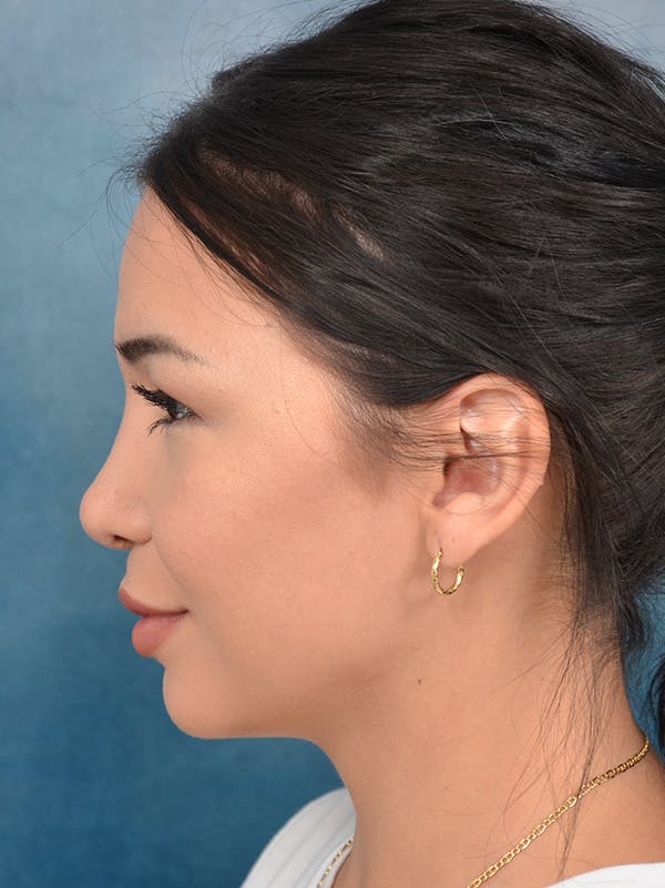 Rhinoplasty Before & After Gallery - Patient 122749877 - Image 2