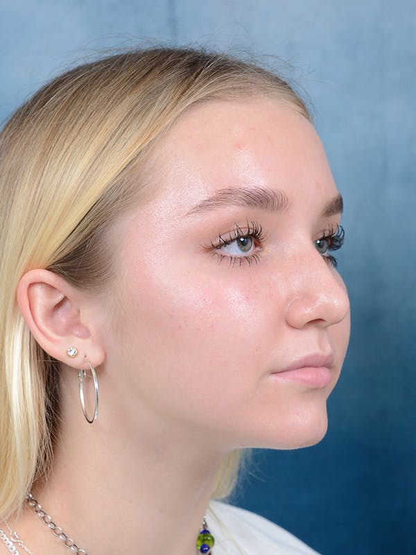 Rhinoplasty Before & After Gallery - Patient 122750226 - Image 5