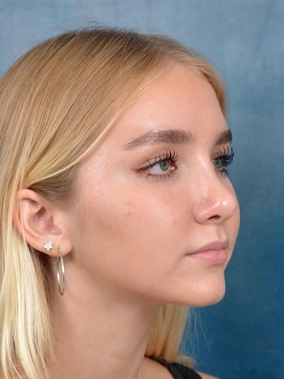 Rhinoplasty Before & After Gallery - Patient 122750226 - Image 6