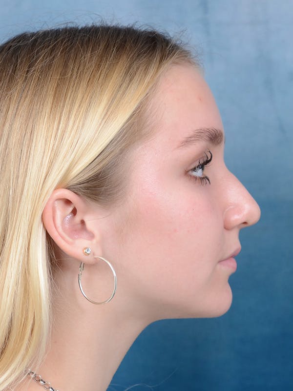 Rhinoplasty Before & After Gallery - Patient 122750226 - Image 7