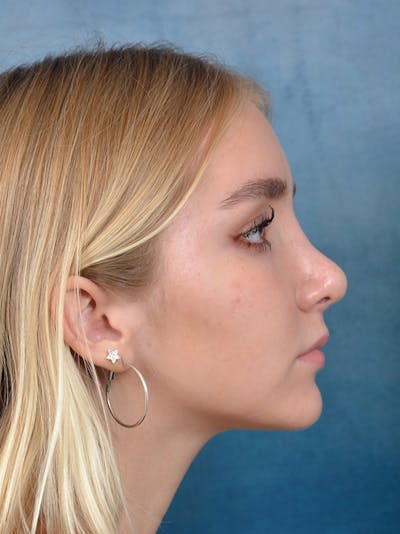 Rhinoplasty Before & After Gallery - Patient 122750226 - Image 8