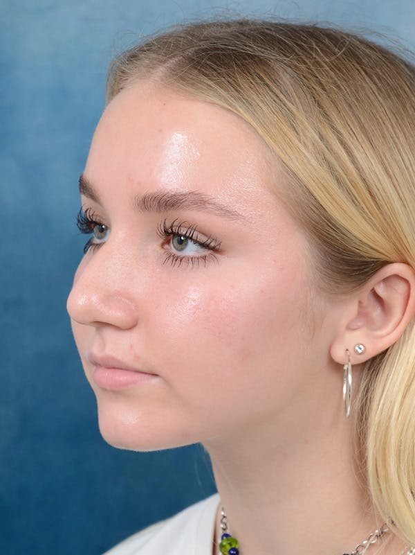 Rhinoplasty Before & After Gallery - Patient 122750226 - Image 9