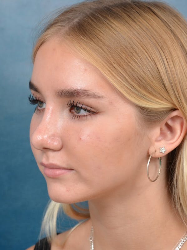 Rhinoplasty Before & After Gallery - Patient 122750226 - Image 10