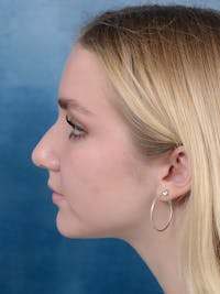 Rhinoplasty Before & After Gallery - Patient 122750226 - Image 1