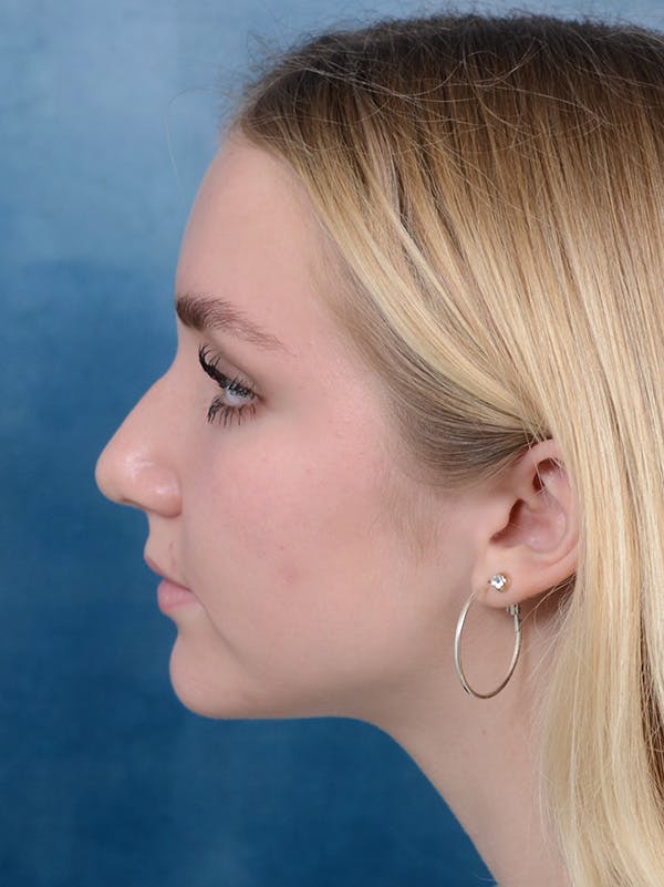 Rhinoplasty Before & After Gallery - Patient 122750226 - Image 1