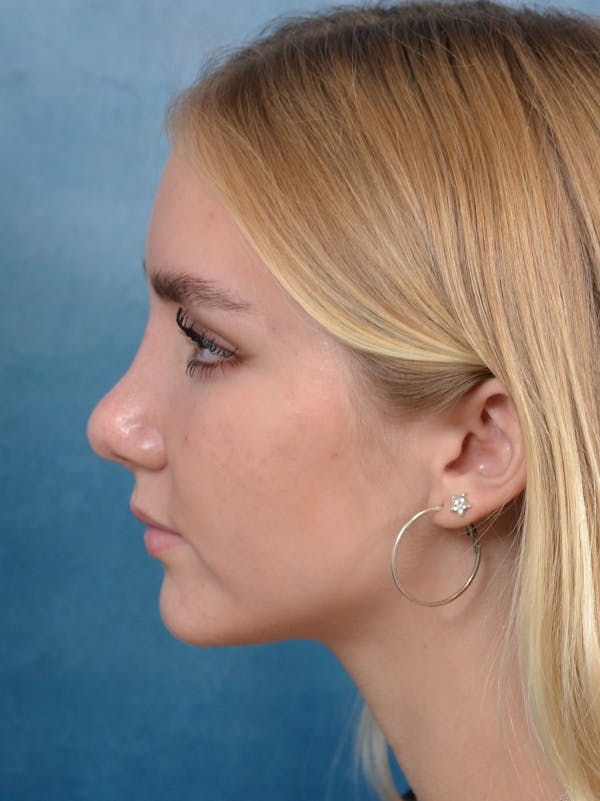 Rhinoplasty Before & After Gallery - Patient 122750226 - Image 2