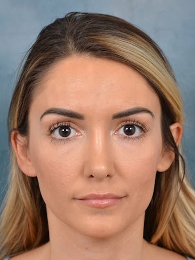 Rhinoplasty Before & After Gallery - Patient 122816191 - Image 4
