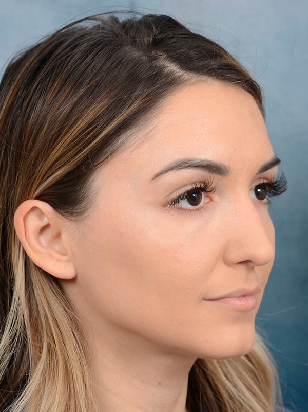 Rhinoplasty Before & After Gallery - Patient 122816191 - Image 5