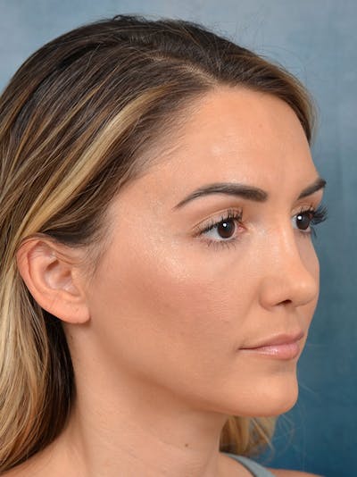 Rhinoplasty Before & After Gallery - Patient 122816191 - Image 6