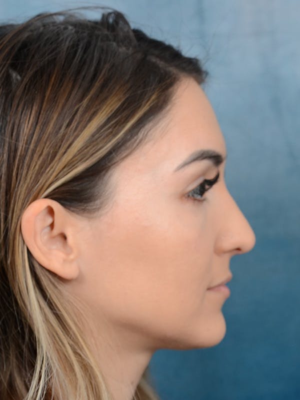 Rhinoplasty Before & After Gallery - Patient 122816191 - Image 7