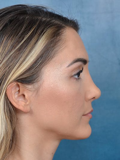 Rhinoplasty Before & After Gallery - Patient 122816191 - Image 8