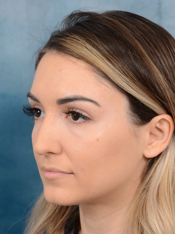 Rhinoplasty Before & After Gallery - Patient 122816191 - Image 9