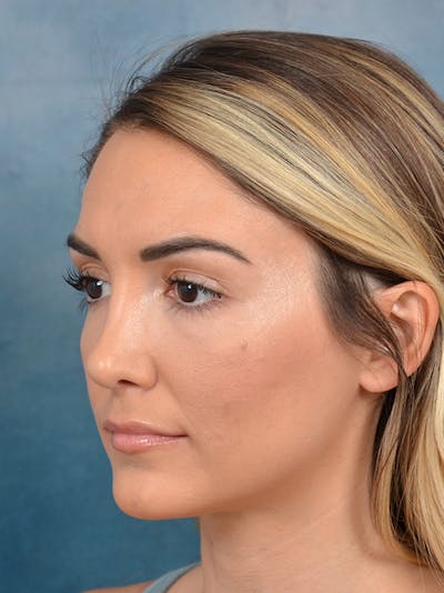 Rhinoplasty Before & After Gallery - Patient 122816191 - Image 10