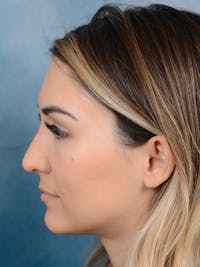 Rhinoplasty Before & After Gallery - Patient 122816191 - Image 1