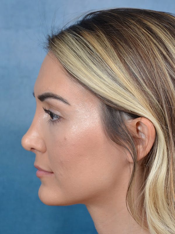 Rhinoplasty Before & After Gallery - Patient 122816191 - Image 2