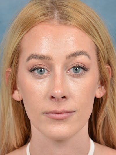 Revision Rhinoplasty Before & After Gallery - Patient 122816202 - Image 4