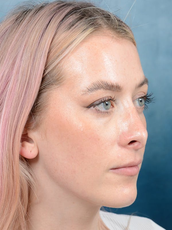 Revision Rhinoplasty Before & After Gallery - Patient 122816202 - Image 5