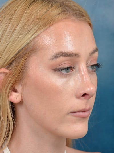 Revision Rhinoplasty Before & After Gallery - Patient 122816202 - Image 6