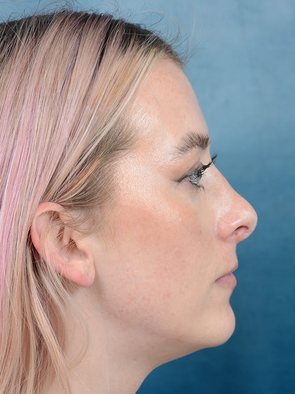Revision Rhinoplasty Gallery - Patient 122816202 - Image 7