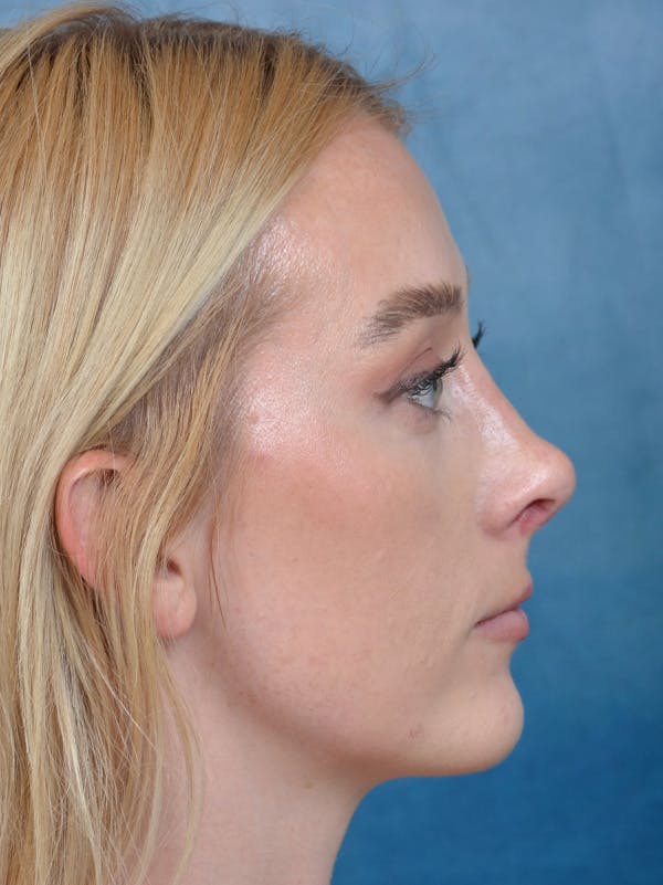 Revision Rhinoplasty Gallery - Patient 122816202 - Image 8
