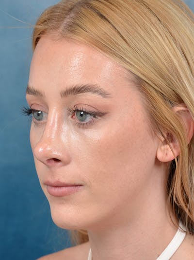 Revision Rhinoplasty Before & After Gallery - Patient 122816202 - Image 10