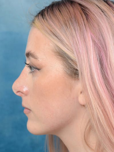 Revision Rhinoplasty Before & After Gallery - Patient 122816202 - Image 1