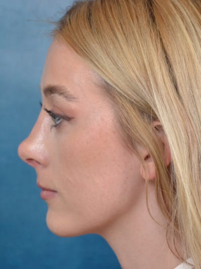 Revision Rhinoplasty Before & After Gallery - Patient 122816202 - Image 2