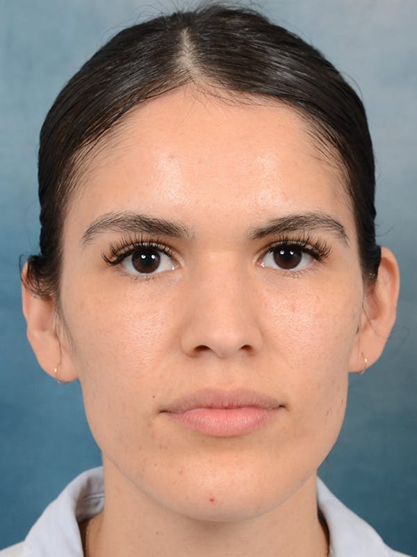 Rhinoplasty Before & After Gallery - Patient 122816205 - Image 3