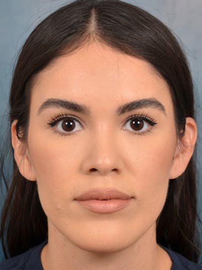 Brow Lift Before & After Gallery - Patient 122816221 - Image 2