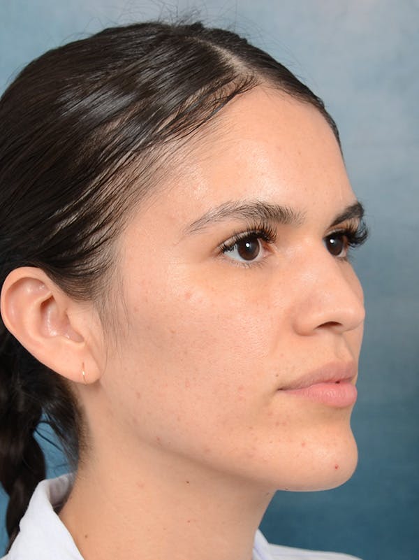 Rhinoplasty Before & After Gallery - Patient 122816205 - Image 5