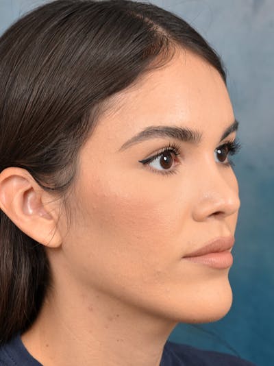 Brow Lift Before & After Gallery - Patient 122816221 - Image 4