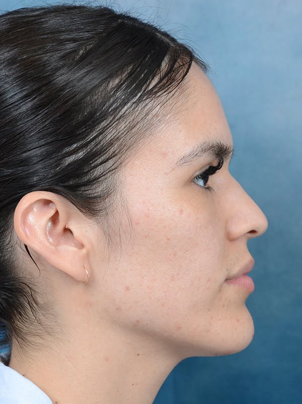 Rhinoplasty Before & After Gallery - Patient 122816205 - Image 7
