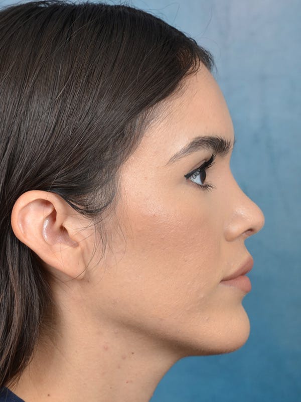 Rhinoplasty Before & After Gallery - Patient 122816205 - Image 8