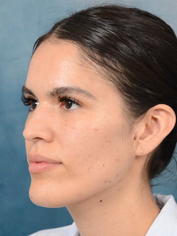 Rhinoplasty Before & After Gallery - Patient 122816205 - Image 9