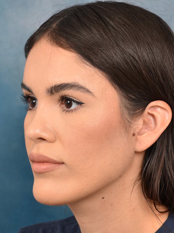 Rhinoplasty Before & After Gallery - Patient 122816205 - Image 10