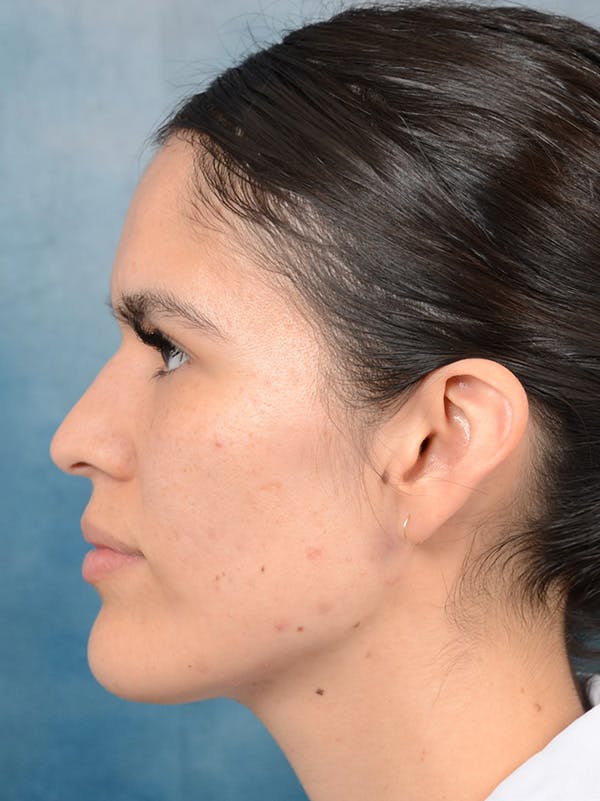 Rhinoplasty Before & After Gallery - Patient 122816205 - Image 1