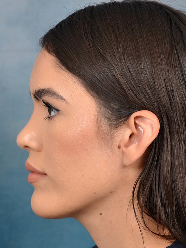 Rhinoplasty Before & After Gallery - Patient 122816205 - Image 2