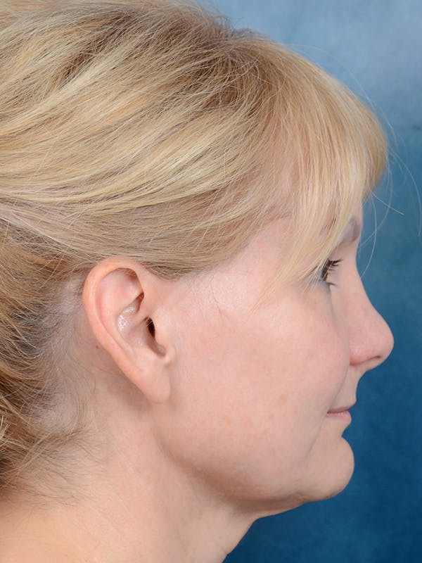 Deep Plane Facelift Before & After Gallery - Patient 121959127 - Image 7