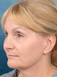 Deep Plane Facelift Before & After Gallery - Patient 121959127 - Image 1