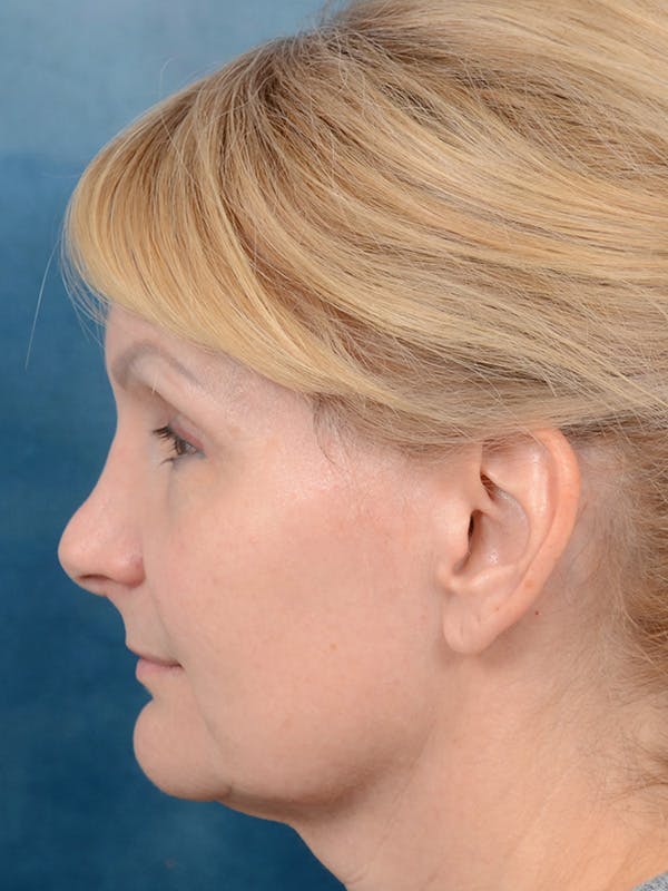 Deep Plane Facelift Before & After Gallery - Patient 121959127 - Image 9