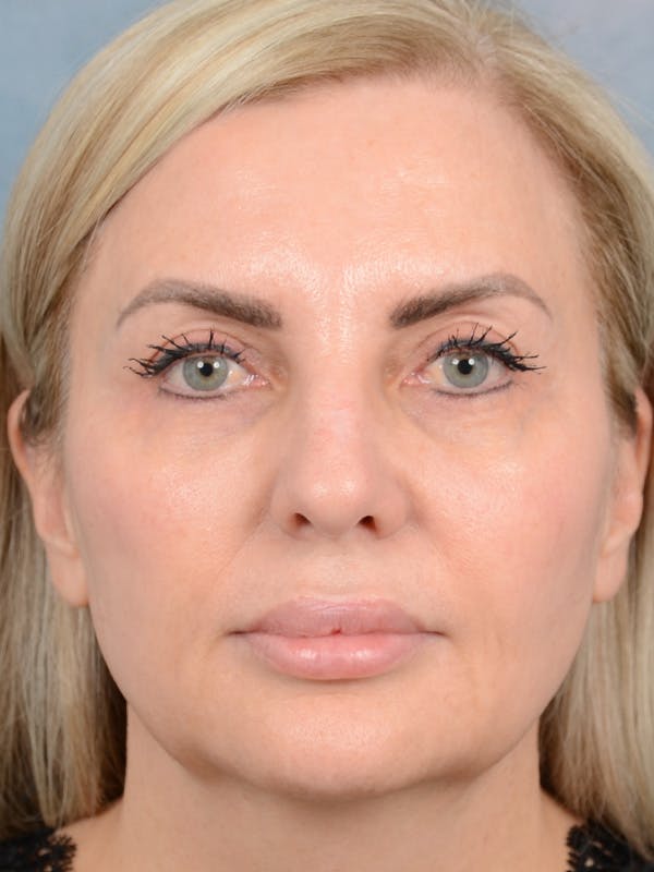 Deep Plane Facelift Before & After Gallery - Patient 123065419 - Image 3