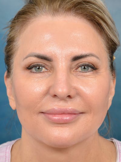Deep Plane Facelift Before & After Gallery - Patient 123065419 - Image 4