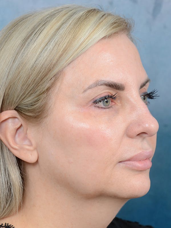 Laser Skin Resurfacing Before & After Gallery - Patient 123065423 - Image 3