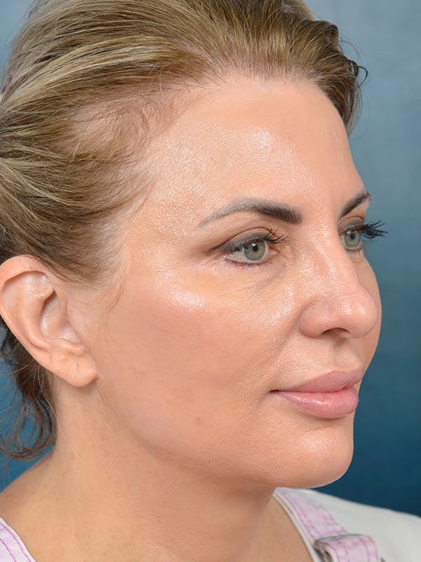 Deep Plane Facelift Before & After Gallery - Patient 123065419 - Image 6