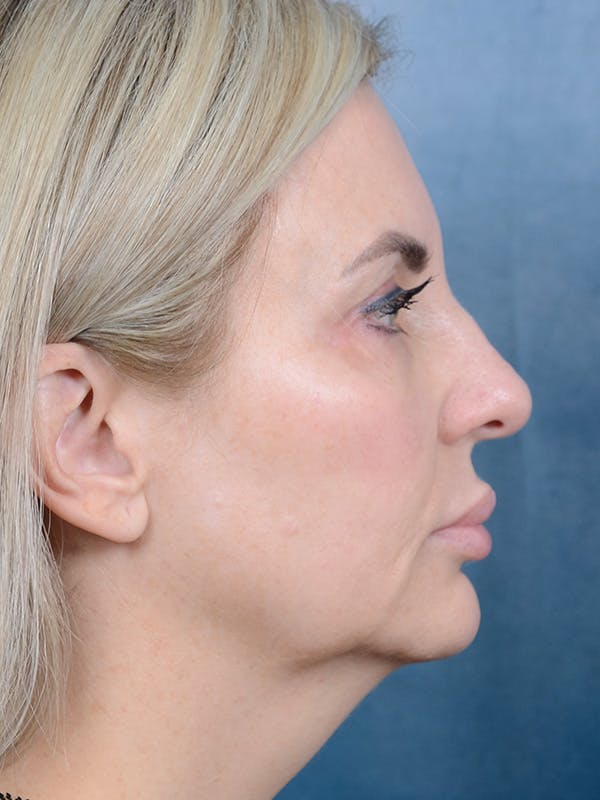 Laser Skin Resurfacing Before & After Gallery - Patient 123065423 - Image 5